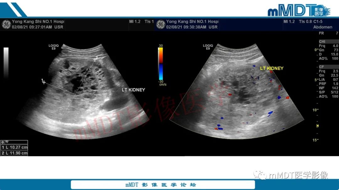 影像PPT - 【病例】肾透明细胞癌1例CT影像-30 影像PPT - 【病例】肾透明细胞癌1例CT影像-30