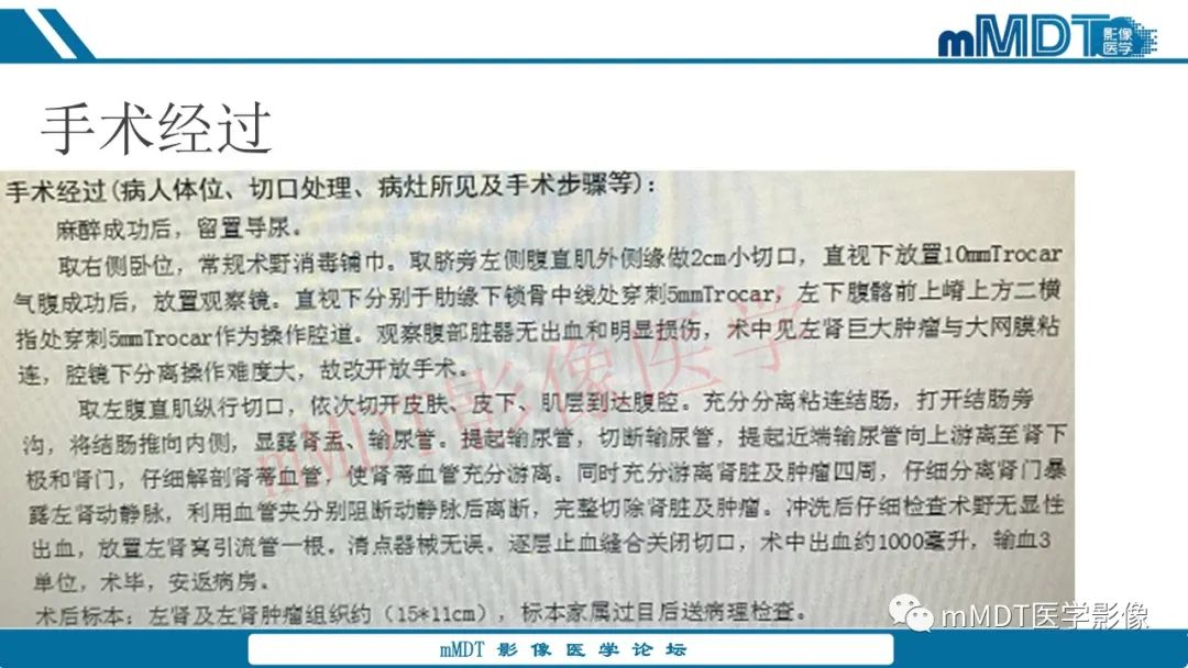 影像PPT - 【病例】肾透明细胞癌1例CT影像-33 影像PPT - 【病例】肾透明细胞癌1例CT影像-33
