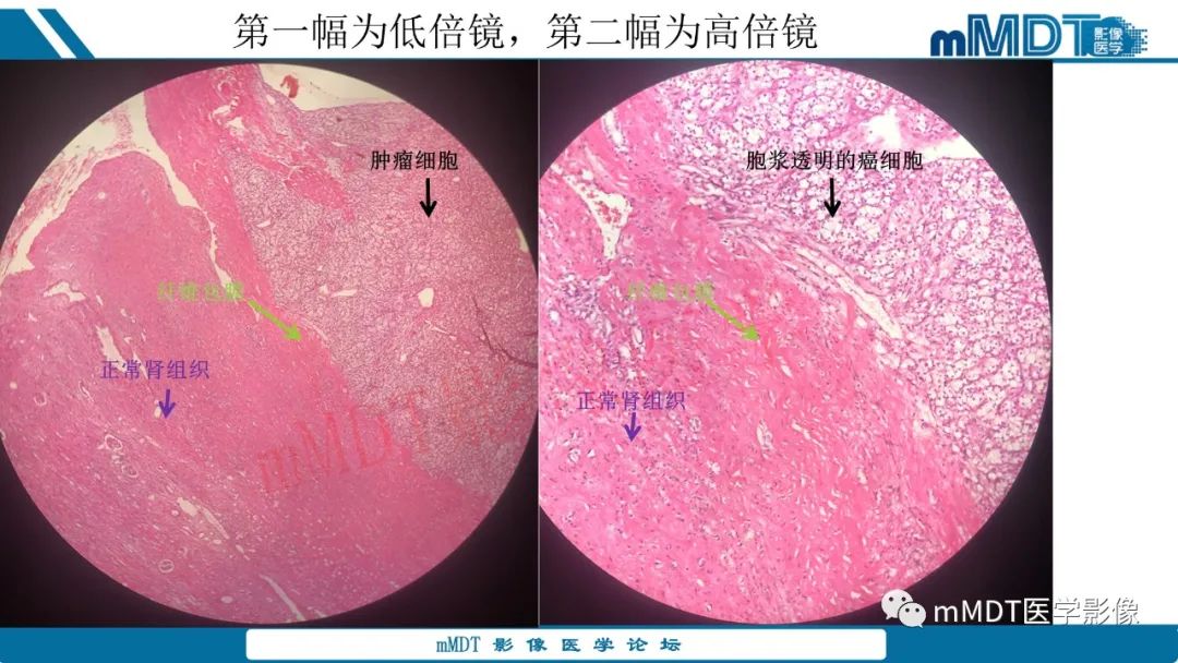 影像PPT - 【病例】肾透明细胞癌1例CT影像-35 影像PPT - 【病例】肾透明细胞癌1例CT影像-35
