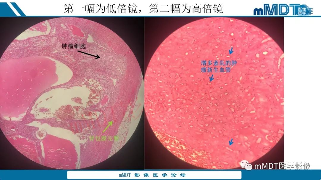 影像PPT - 【病例】肾透明细胞癌1例CT影像-36 影像PPT - 【病例】肾透明细胞癌1例CT影像-36