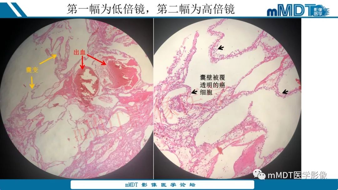 影像PPT - 【病例】肾透明细胞癌1例CT影像-37 影像PPT - 【病例】肾透明细胞癌1例CT影像-37