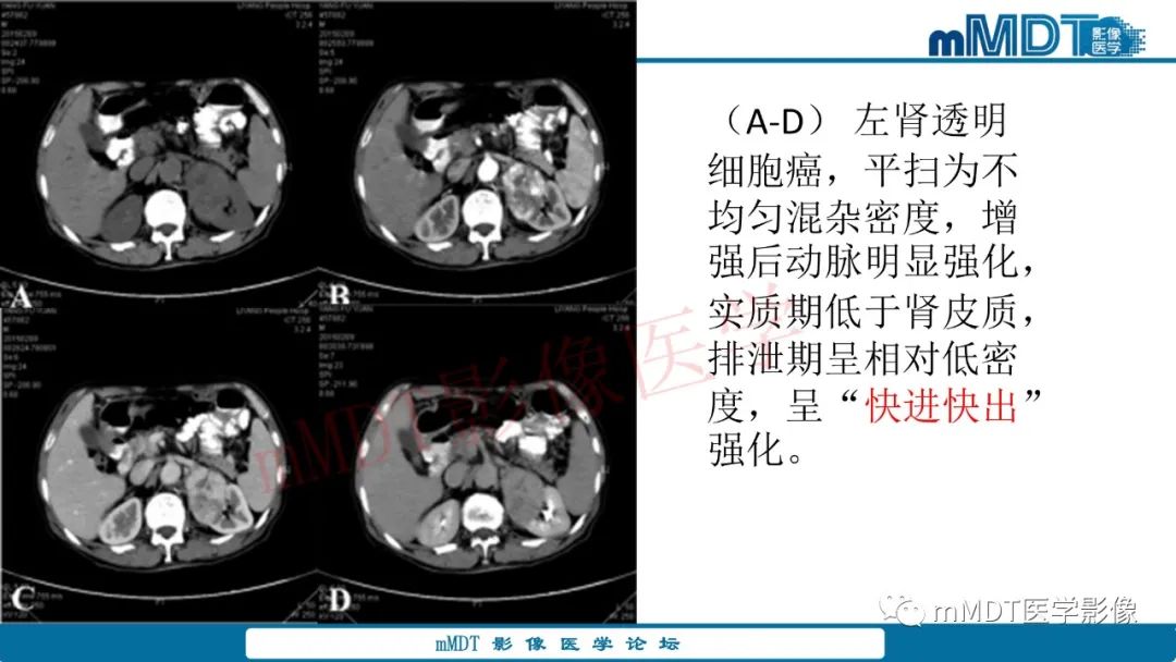影像PPT - 【病例】肾透明细胞癌1例CT影像-39 影像PPT - 【病例】肾透明细胞癌1例CT影像-39