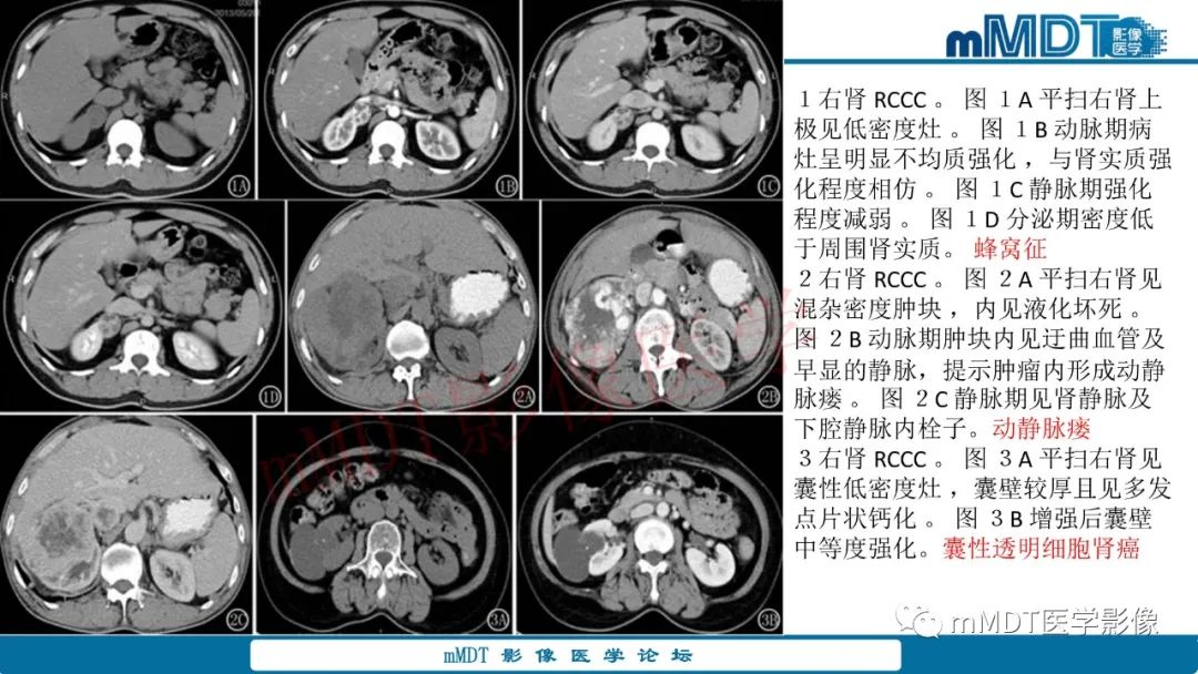 影像PPT - 【病例】肾透明细胞癌1例CT影像-40 影像PPT - 【病例】肾透明细胞癌1例CT影像-40