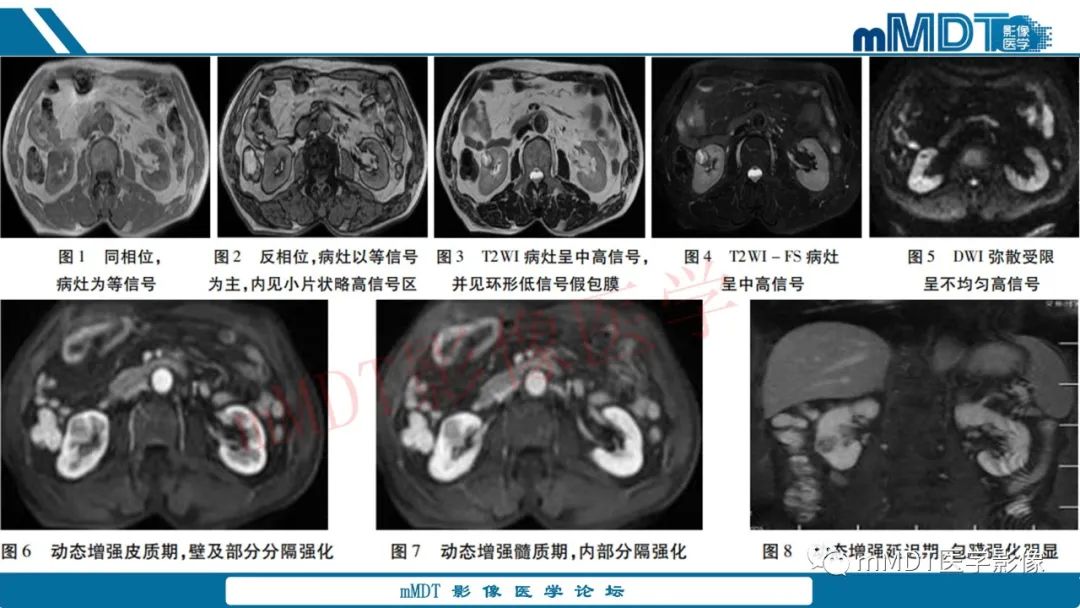 影像PPT - 【病例】肾透明细胞癌1例CT影像-43 影像PPT - 【病例】肾透明细胞癌1例CT影像-43