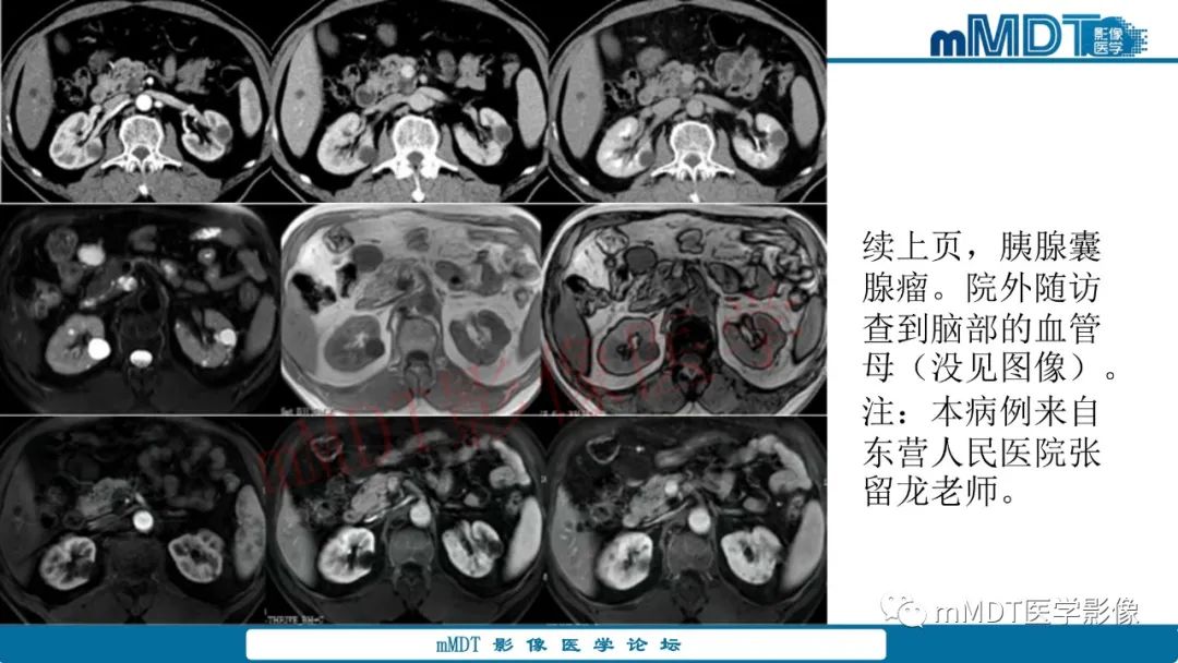 影像PPT - 【病例】肾透明细胞癌1例CT影像-47 影像PPT - 【病例】肾透明细胞癌1例CT影像-47