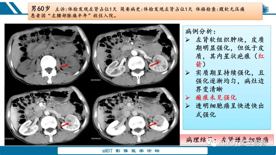 影像PPT - 【病例】肾透明细胞癌1例CT影像-50 影像PPT - 【病例】肾透明细胞癌1例CT影像-50