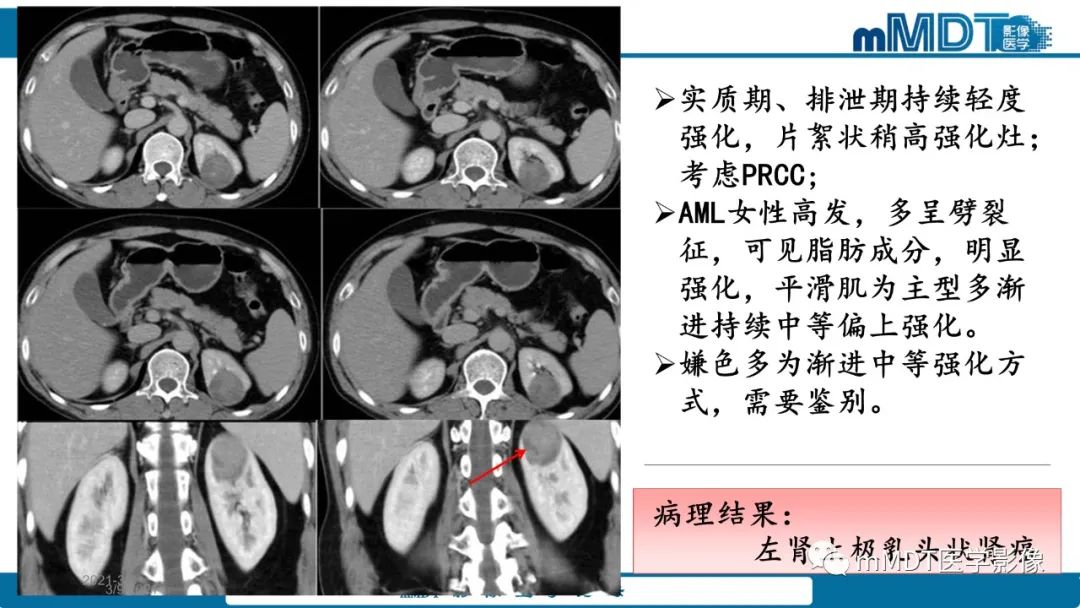 影像PPT - 【病例】肾透明细胞癌1例CT影像-52 影像PPT - 【病例】肾透明细胞癌1例CT影像-52