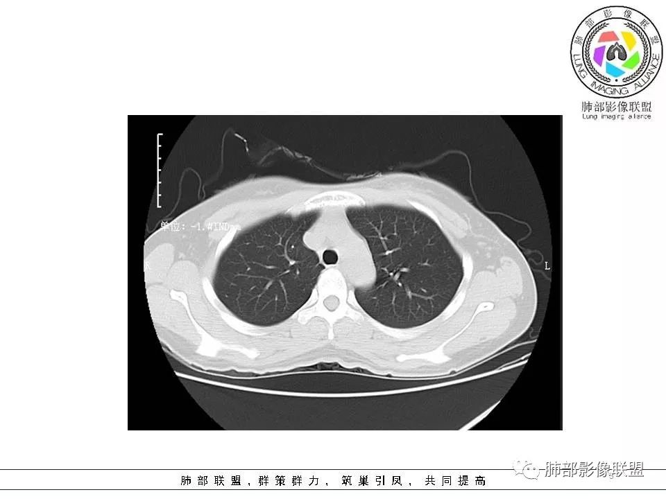 影像PPT - 【病例】欲盖弥彰的肺磨玻璃结节-3 影像PPT - 【病例】欲盖弥彰的肺磨玻璃结节-3