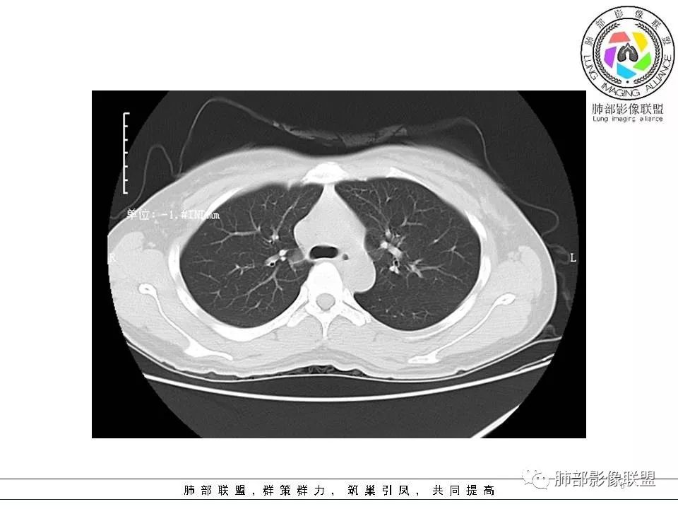 影像PPT - 【病例】欲盖弥彰的肺磨玻璃结节-6 影像PPT - 【病例】欲盖弥彰的肺磨玻璃结节-6