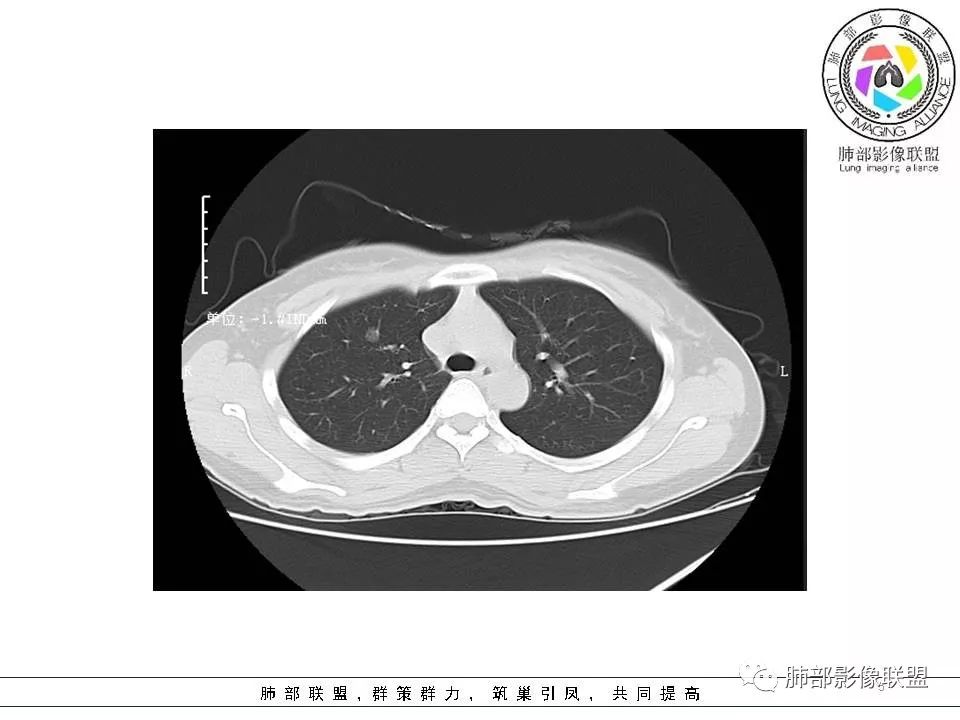 影像PPT - 【病例】欲盖弥彰的肺磨玻璃结节-4 影像PPT - 【病例】欲盖弥彰的肺磨玻璃结节-4