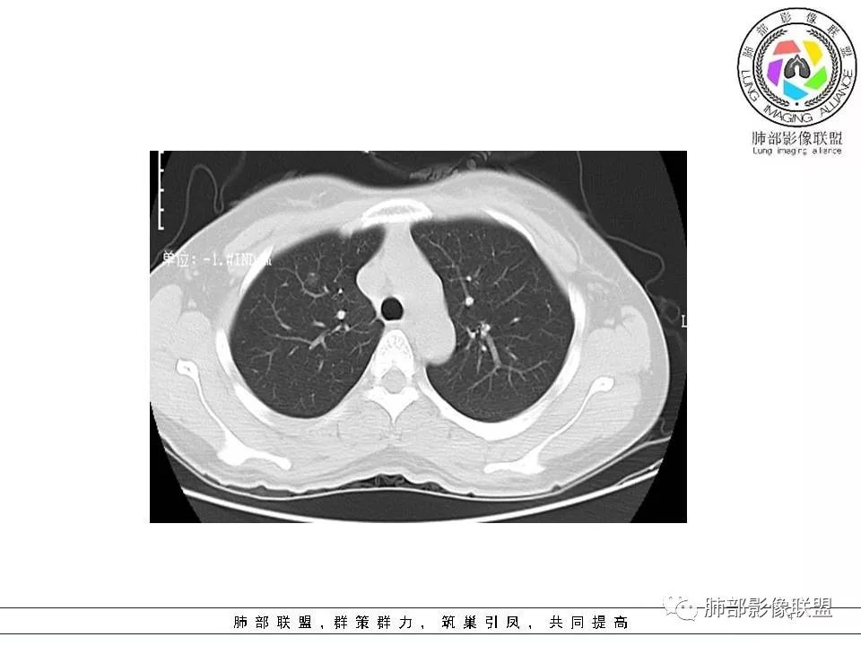 影像PPT - 【病例】欲盖弥彰的肺磨玻璃结节-5 影像PPT - 【病例】欲盖弥彰的肺磨玻璃结节-5