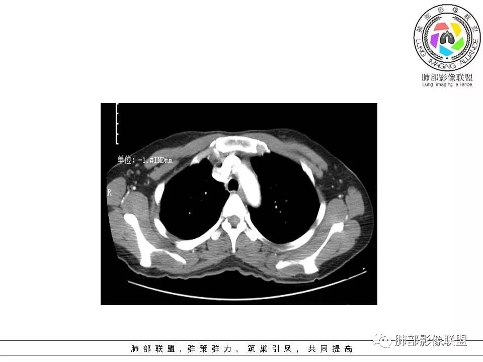 影像PPT - 【病例】欲盖弥彰的肺磨玻璃结节-7 影像PPT - 【病例】欲盖弥彰的肺磨玻璃结节-7