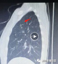 影像PPT - 【病例】欲盖弥彰的肺磨玻璃结节-11 影像PPT - 【病例】欲盖弥彰的肺磨玻璃结节-11