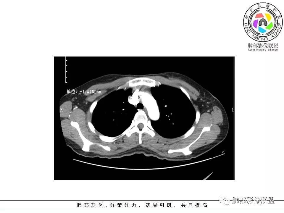 影像PPT - 【病例】欲盖弥彰的肺磨玻璃结节-8 影像PPT - 【病例】欲盖弥彰的肺磨玻璃结节-8