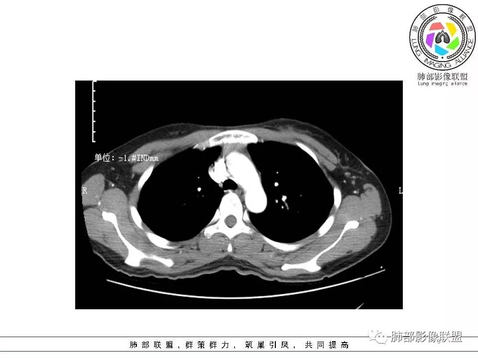 影像PPT - 【病例】欲盖弥彰的肺磨玻璃结节-9 影像PPT - 【病例】欲盖弥彰的肺磨玻璃结节-9