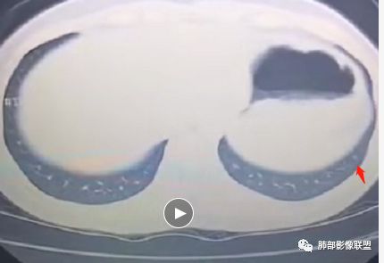 影像PPT - 【病例】欲盖弥彰的肺磨玻璃结节-13 影像PPT - 【病例】欲盖弥彰的肺磨玻璃结节-13