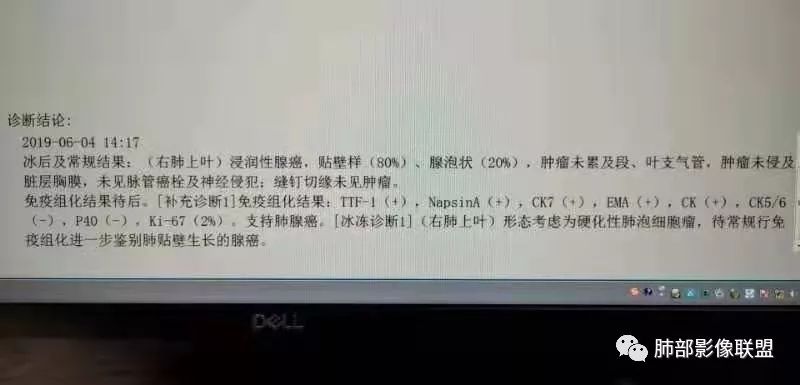 影像PPT - 【病例】欲盖弥彰的肺磨玻璃结节-16 影像PPT - 【病例】欲盖弥彰的肺磨玻璃结节-16