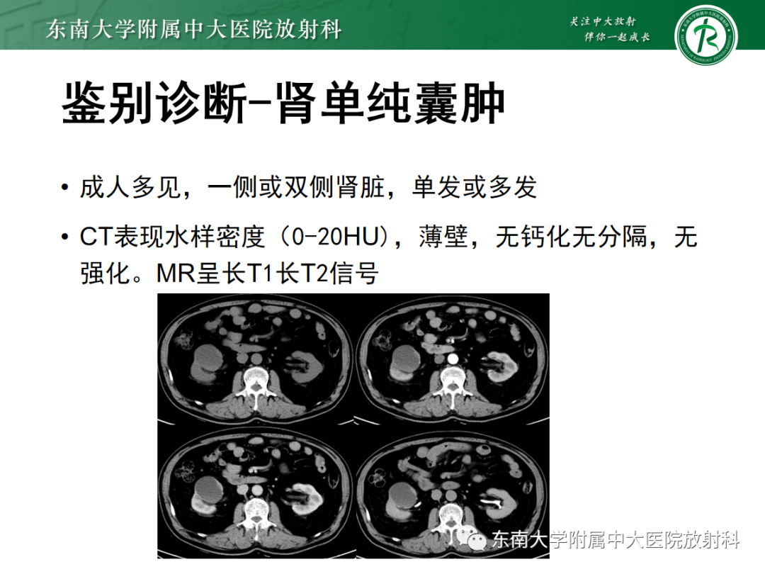 影像PPT - 【PPT】囊性肾癌的影像-18