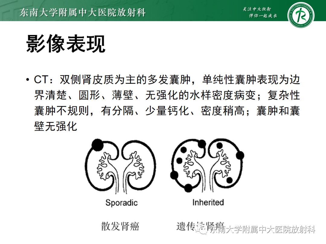 影像PPT - 【PPT】囊性肾癌的影像-21