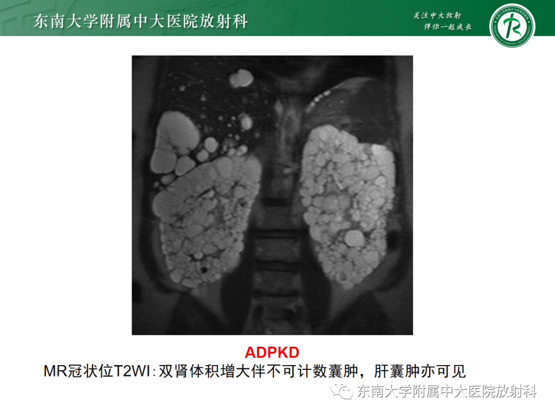 影像PPT - 【PPT】囊性肾癌的影像-24