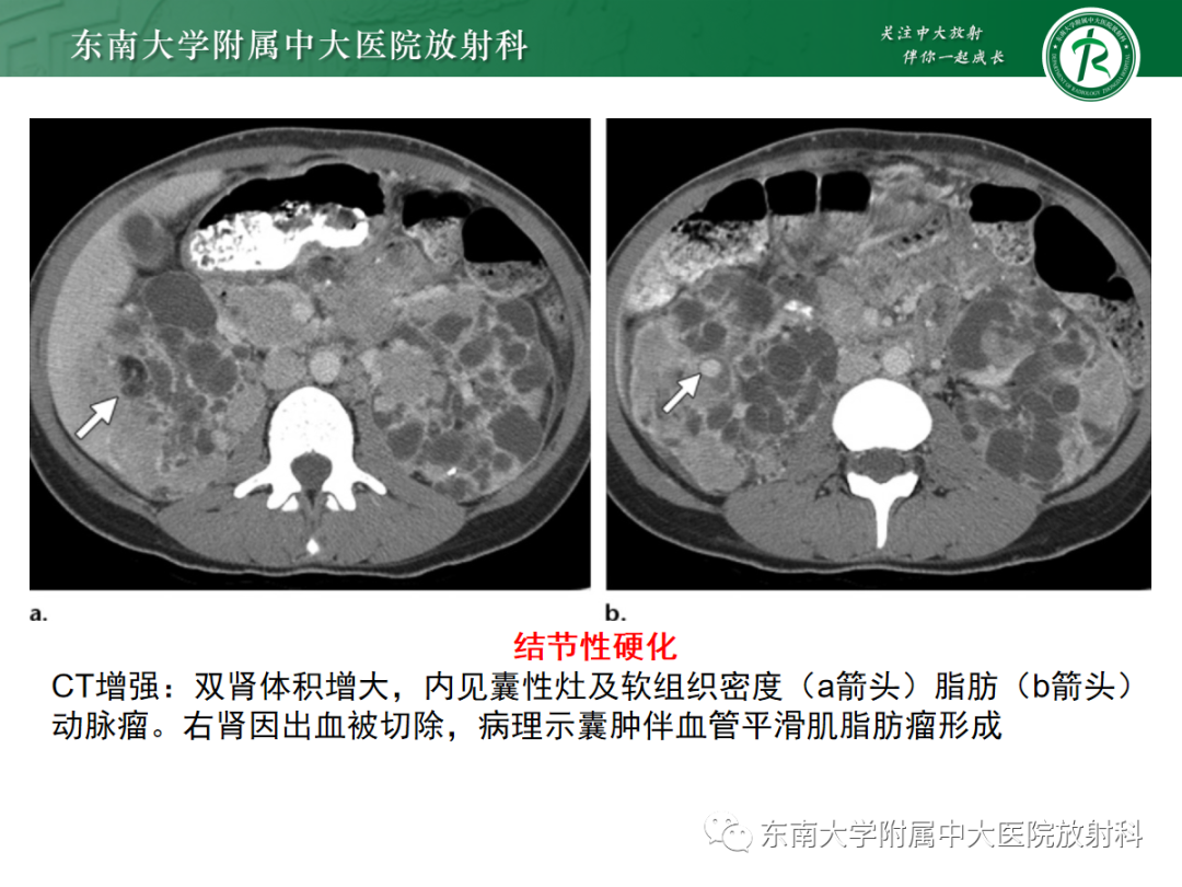 影像PPT - 【PPT】囊性肾癌的影像-26