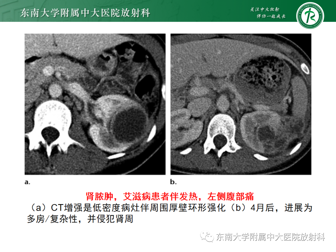 影像PPT - 【PPT】囊性肾癌的影像-28