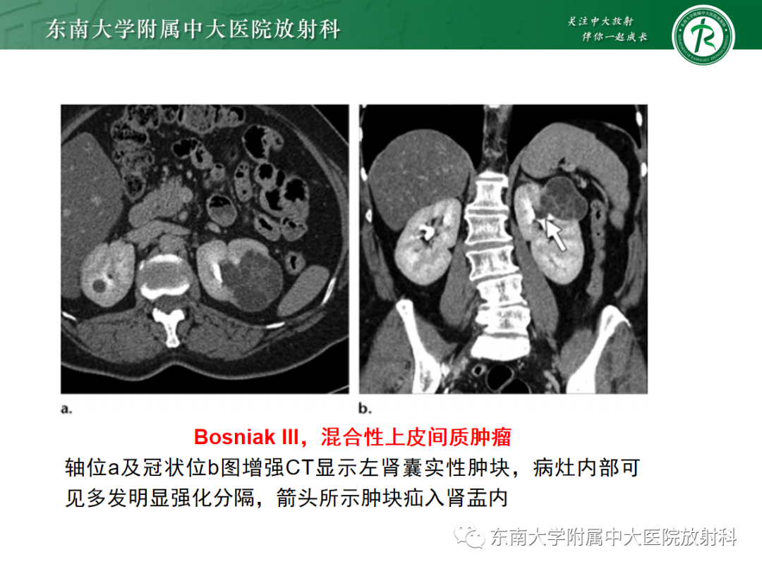 影像PPT - 【PPT】囊性肾癌的影像-32