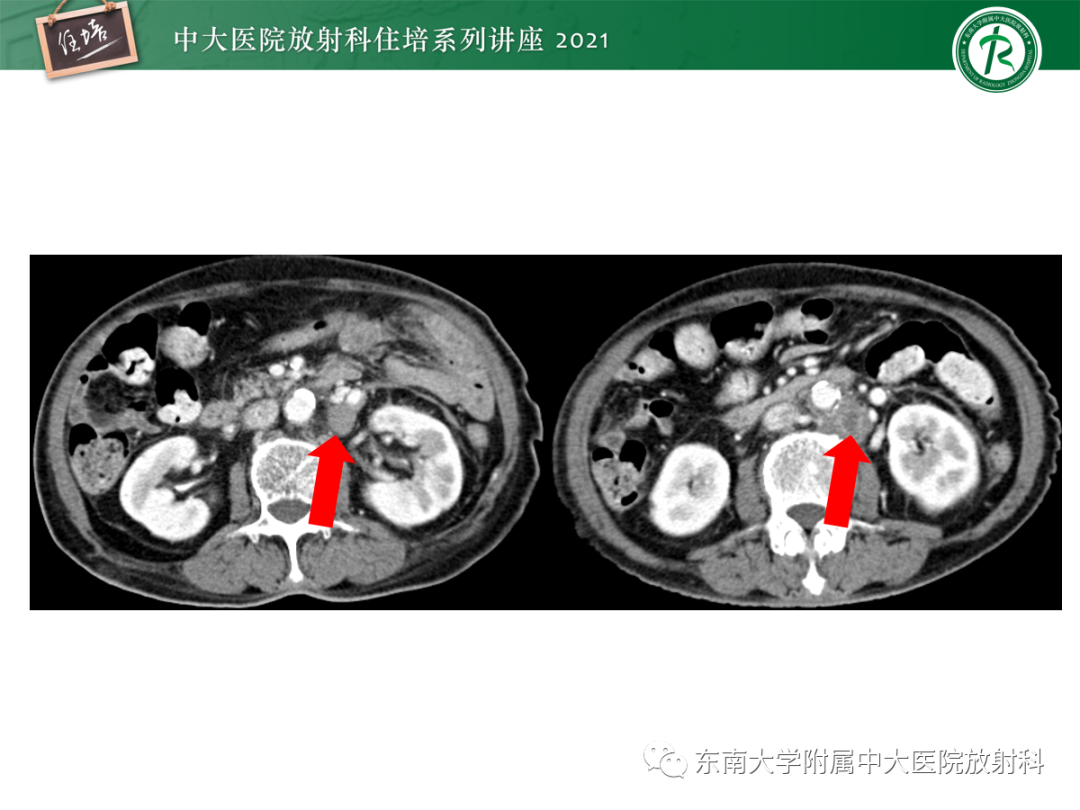 影像PPT - 【PPT】双侧肾上腺病变的影像诊断思路-5