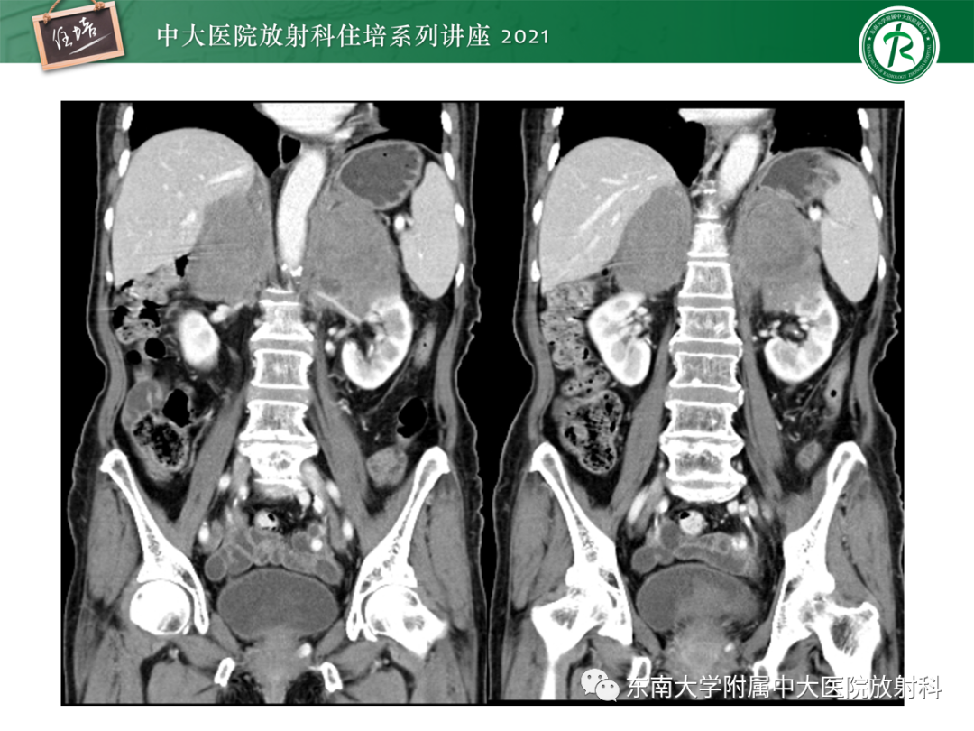 影像PPT - 【PPT】双侧肾上腺病变的影像诊断思路-4