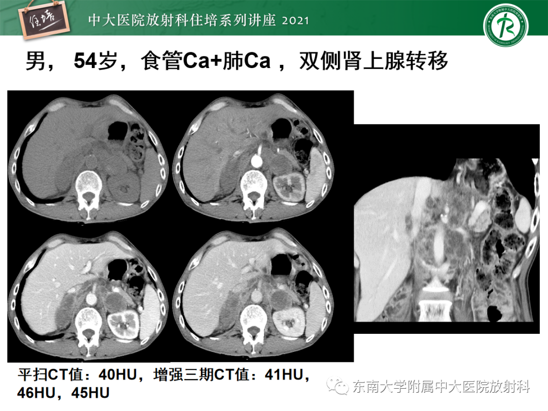 影像PPT - 【PPT】双侧肾上腺病变的影像诊断思路-9