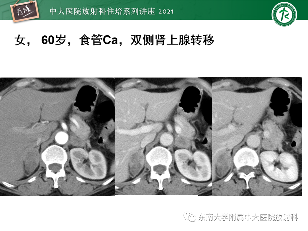 影像PPT - 【PPT】双侧肾上腺病变的影像诊断思路-10