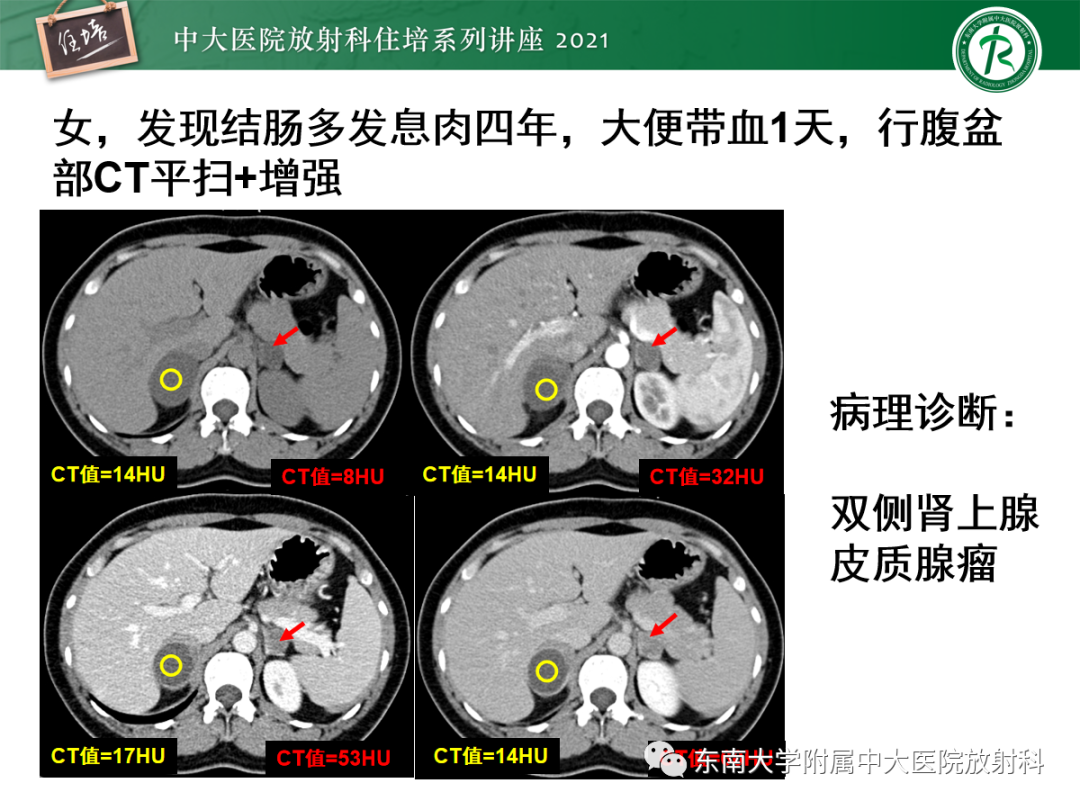 影像PPT - 【PPT】双侧肾上腺病变的影像诊断思路-12