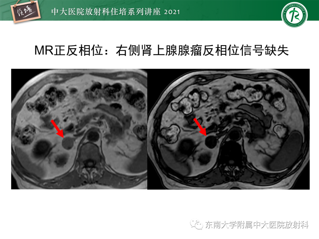 影像PPT - 【PPT】双侧肾上腺病变的影像诊断思路-14