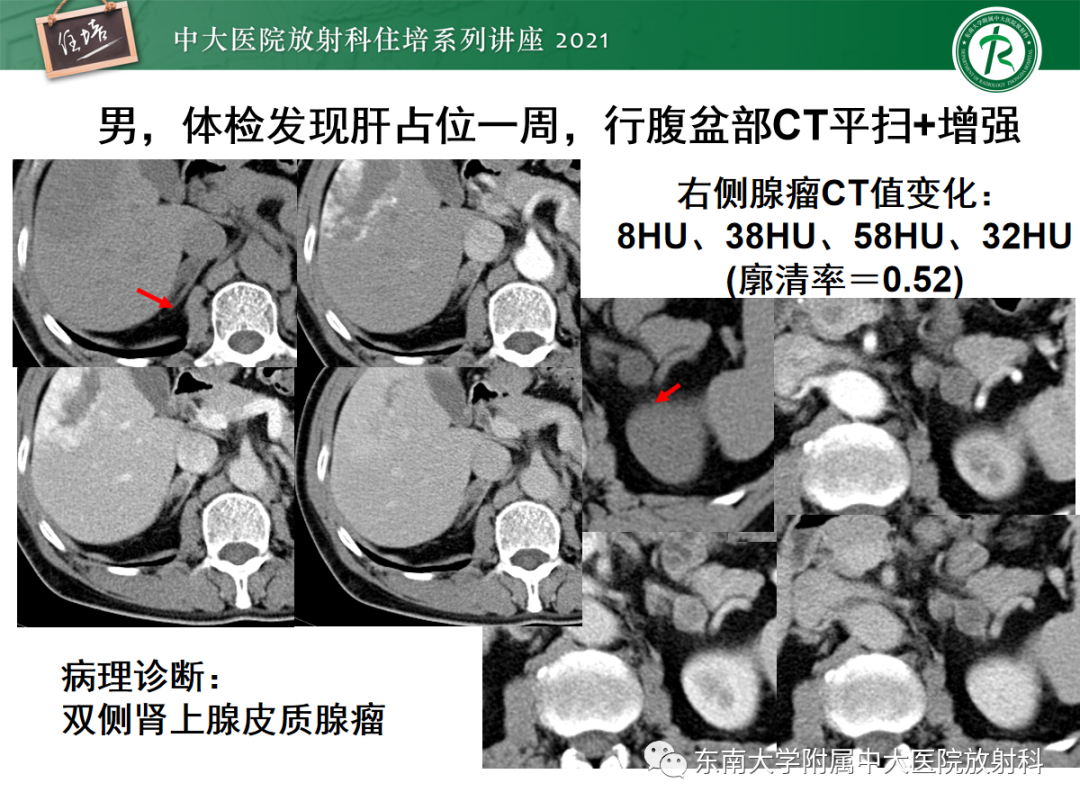 影像PPT - 【PPT】双侧肾上腺病变的影像诊断思路-13