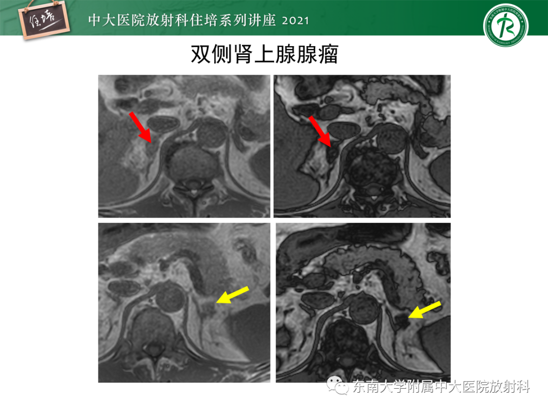 影像PPT - 【PPT】双侧肾上腺病变的影像诊断思路-15
