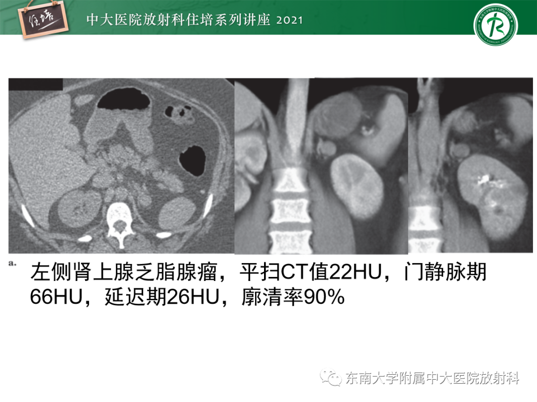 影像PPT - 【PPT】双侧肾上腺病变的影像诊断思路-16