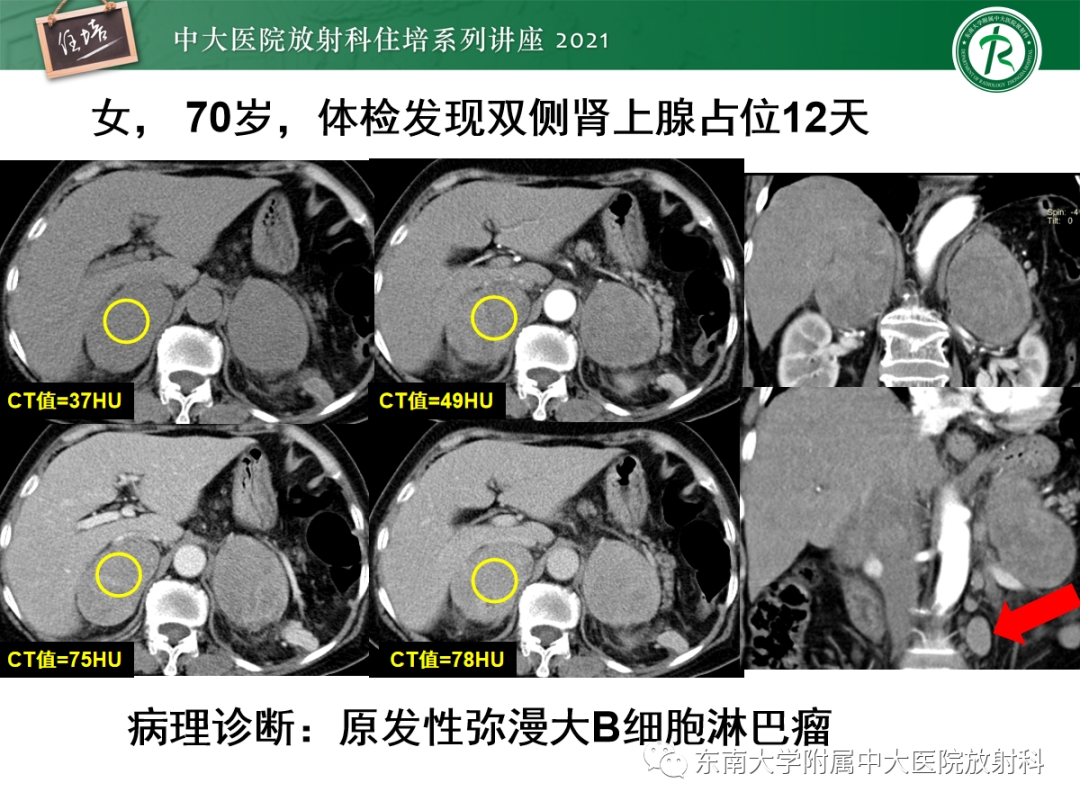 影像PPT - 【PPT】双侧肾上腺病变的影像诊断思路-19