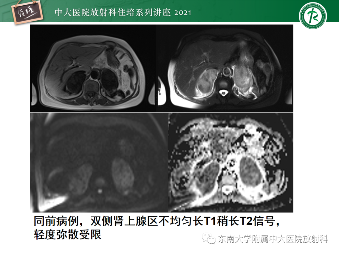 影像PPT - 【PPT】双侧肾上腺病变的影像诊断思路-20