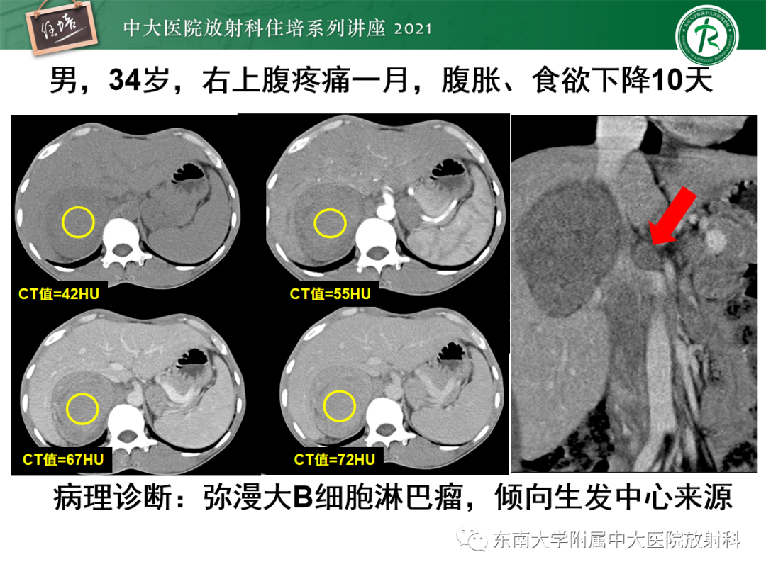 影像PPT - 【PPT】双侧肾上腺病变的影像诊断思路-21