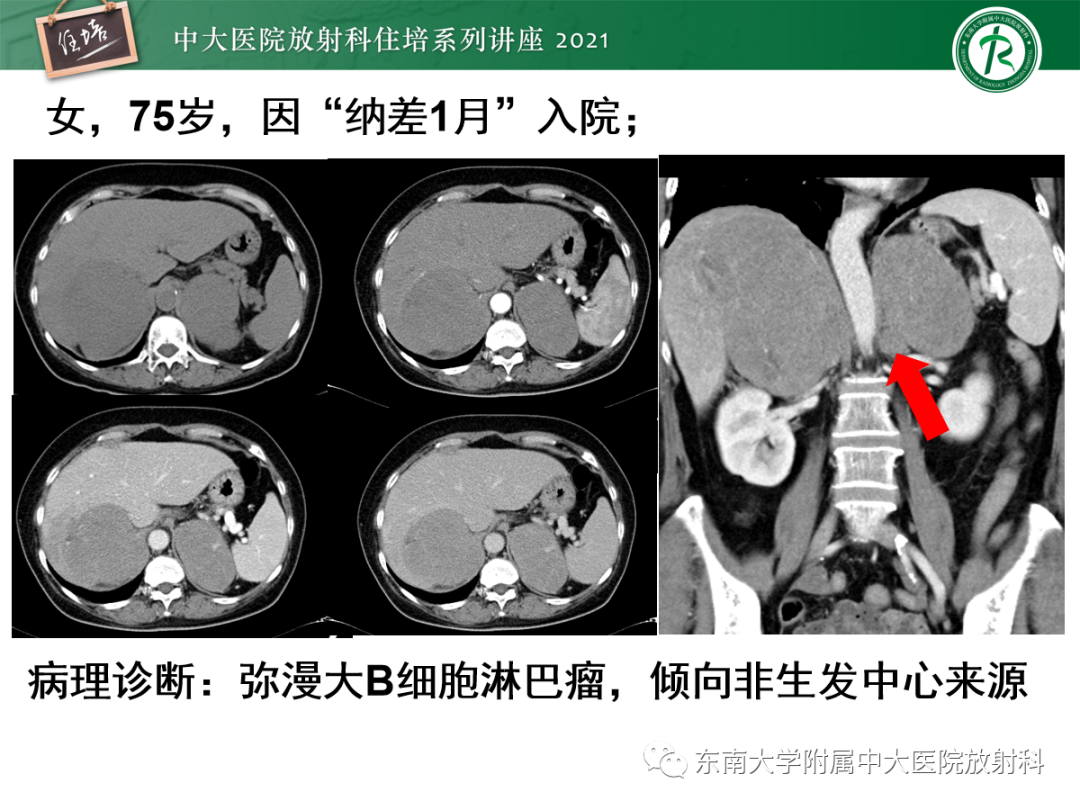 影像PPT - 【PPT】双侧肾上腺病变的影像诊断思路-22