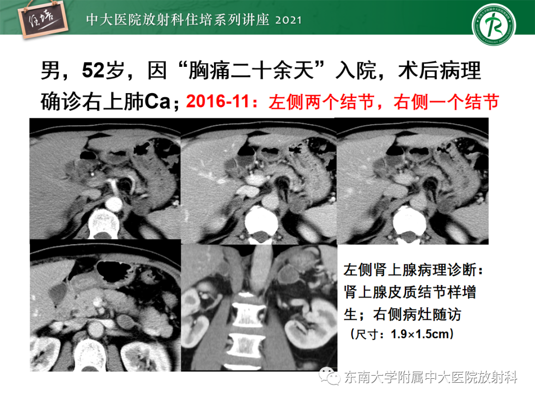 影像PPT - 【PPT】双侧肾上腺病变的影像诊断思路-27