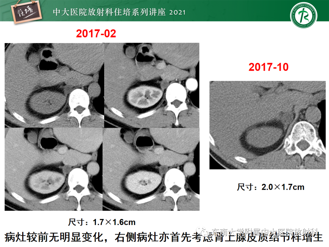 影像PPT - 【PPT】双侧肾上腺病变的影像诊断思路-28