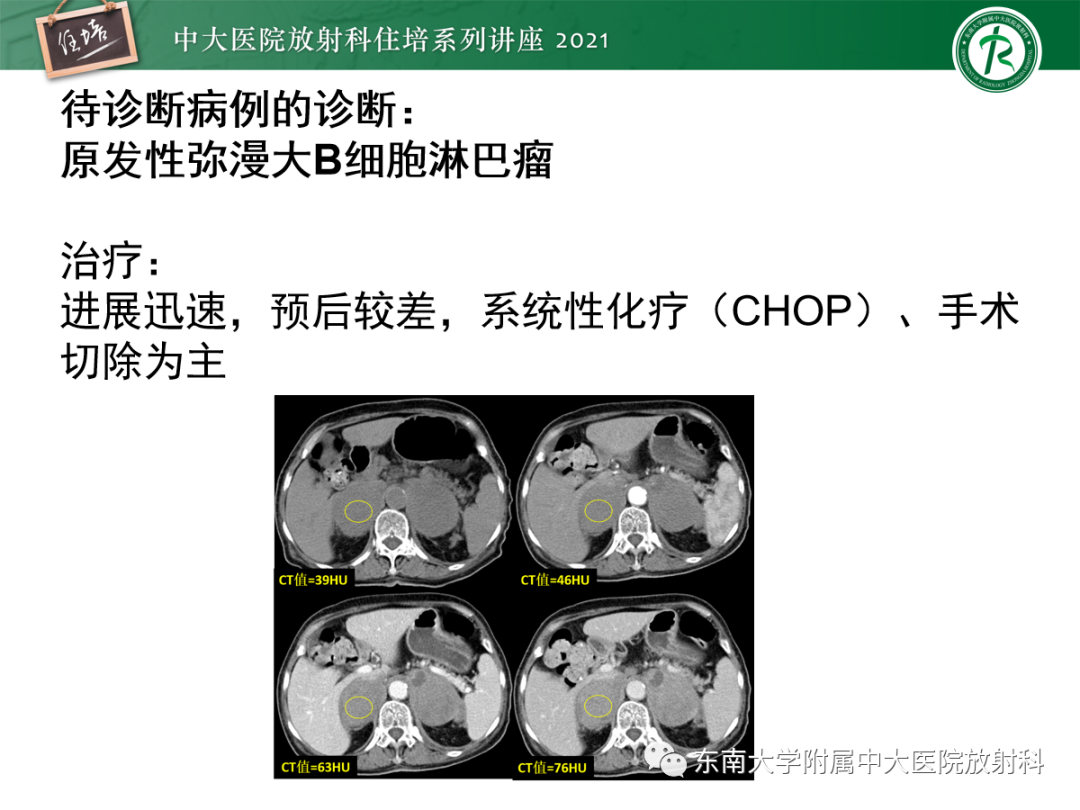 影像PPT - 【PPT】双侧肾上腺病变的影像诊断思路-32