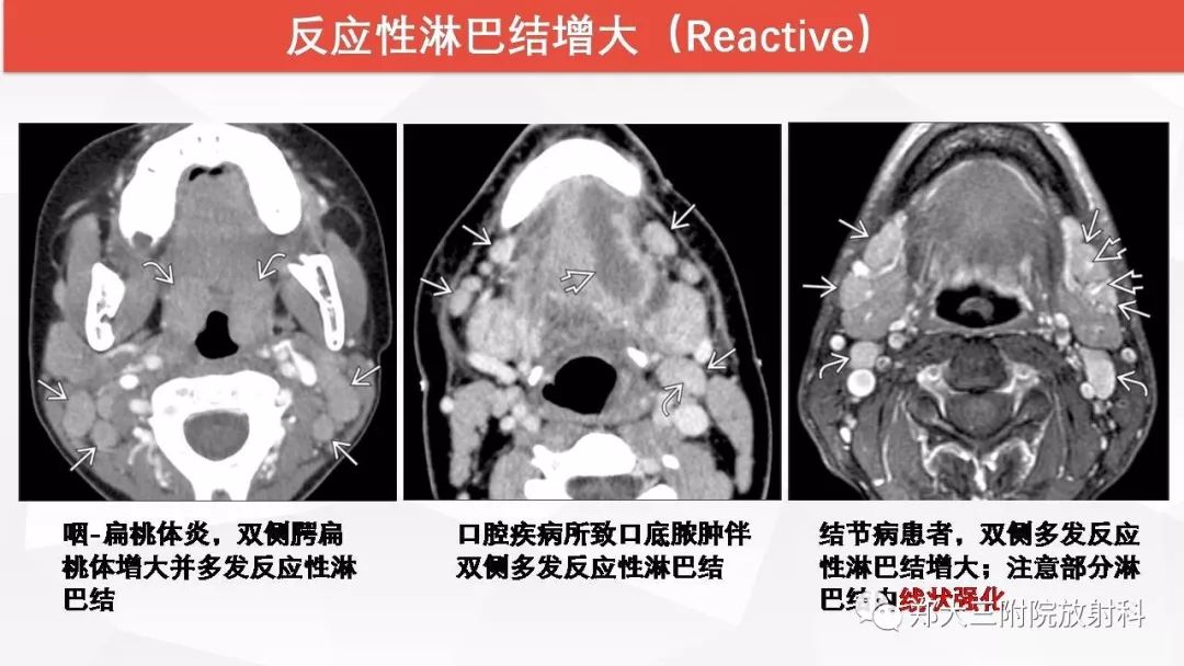 影像PPT - 【PPT】颈部淋巴结肿大的鉴别诊断-11