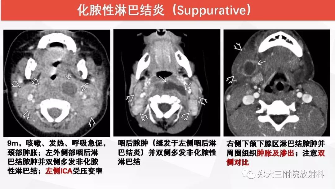 影像PPT - 【PPT】颈部淋巴结肿大的鉴别诊断-13