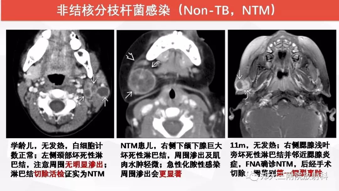 影像PPT - 【PPT】颈部淋巴结肿大的鉴别诊断-15