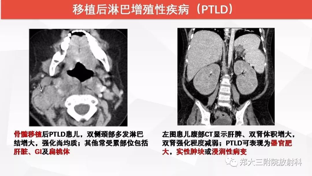 影像PPT - 【PPT】颈部淋巴结肿大的鉴别诊断-19
