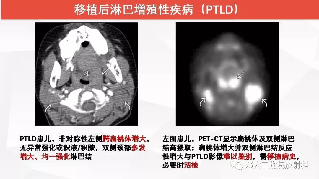 影像PPT - 【PPT】颈部淋巴结肿大的鉴别诊断-20