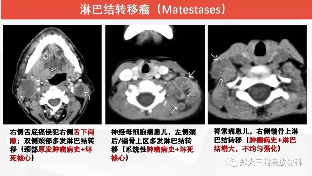 影像PPT - 【PPT】颈部淋巴结肿大的鉴别诊断-23
