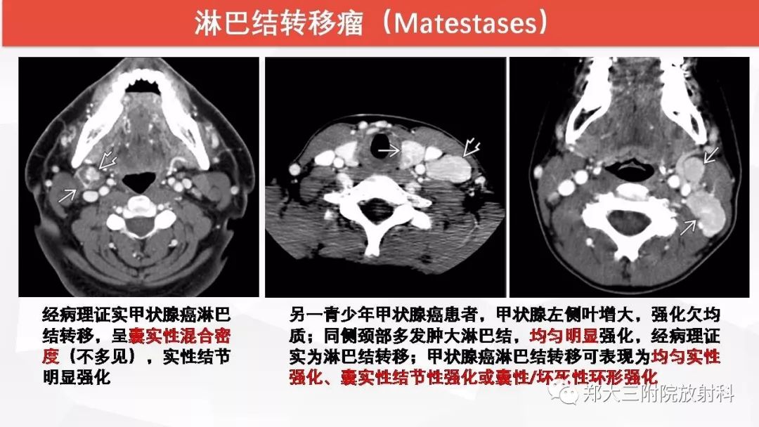 影像PPT - 【PPT】颈部淋巴结肿大的鉴别诊断-24